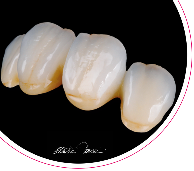 ceraMotion&reg; Verblendkeramik
